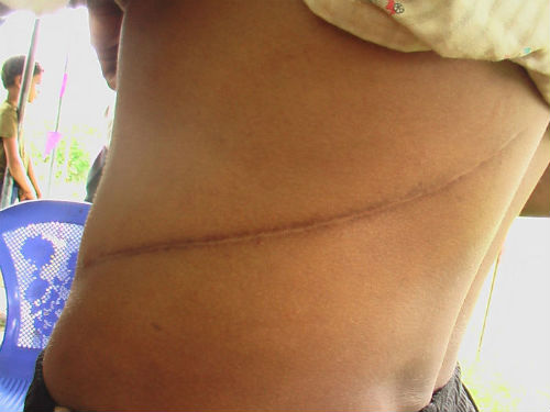 Тосгоны бүх хүн өрөөсөн бөөрөө заржээ